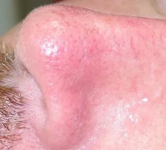 zamykanie naczynek lublin