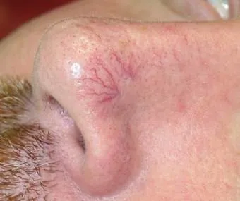 zamykanie naczynek lublin