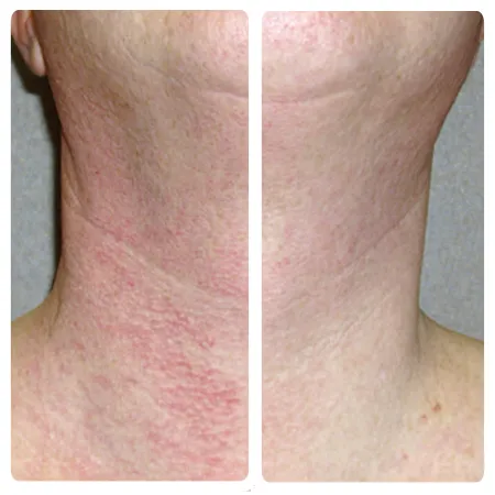 zamykanie naczynek lublin