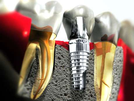 implanty zębowe lublin