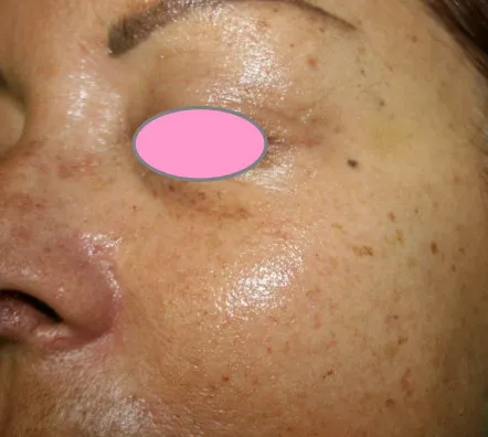 mezoterapia igłowa lublin