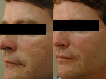 peeling chemiczny efekty przed i po