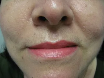 usunięcie laserowe po