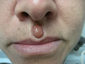 usunięcie laserowe przed