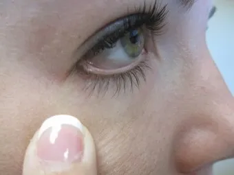 usunięcie zmiany chirurgiczne po