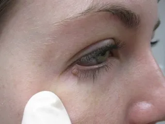 usunięcie zmiany chirurgiczne przed